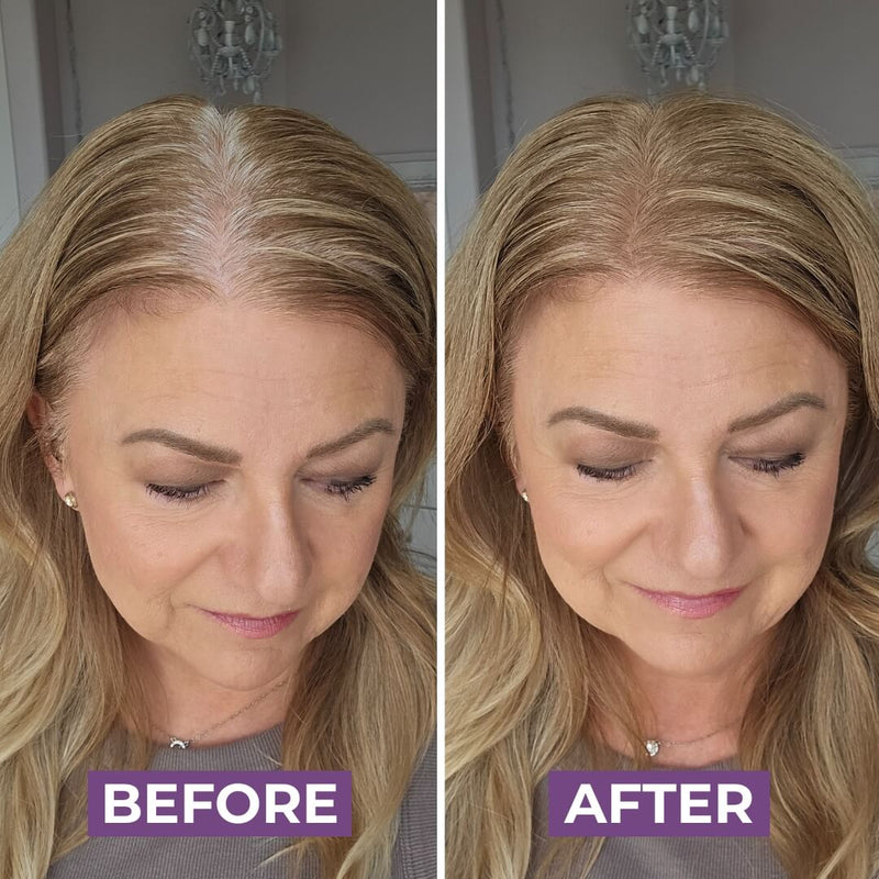 Emily R.’s hair before HairMagic+ Hairline Powder