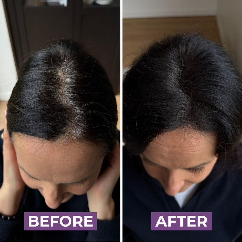 Linda P.’s hair before HairMagic+ Hairline Powder